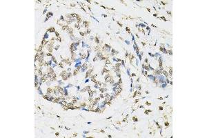 Immunohistochemistry of paraffin-embedded human esophageal cancer using PSMB1 antibody. (PSMB1 anticorps  (AA 29-241))