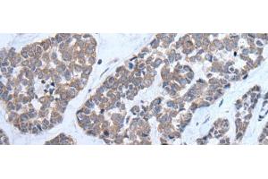 Immunohistochemistry of paraffin-embedded Human esophagus cancer tissue using CNTN1 Polyclonal Antibody at dilution of 1:35(x200)