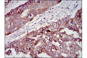 Immunohistochemical analysis of paraffin-embedded ovarian cancer tissues using IGF2 mouse mAb with DAB staining.