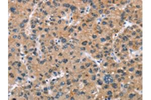 The image on the left is immunohistochemistry of paraffin-embedded Human liver cancer tissue using ABIN7189673(ADGRB2 Antibody) at dilution 1/25, on the right is treated with synthetic peptide. (BAI2 anticorps)