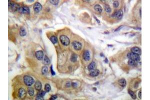 Immunohistochemistry analyzes of ErbB-3 antibody in paraffin-embedded human breast carcinoma tissue. (ERBB3 anticorps)