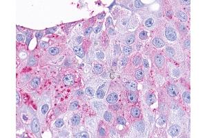 Anti-TAAR9 antibody IHC of human Breast, Carcinoma. (TAAR9 anticorps  (C-Term))