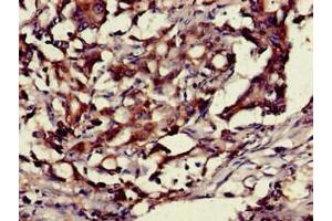 Immunohistochemistry of paraffin-embedded human gastric cancer using ABIN7155201 at dilution of 1:100