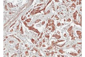 IHC-P Image Immunohistochemical analysis of paraffin-embedded human breast cancer, using TULP1, antibody at 1:100 dilution. (TULP1 anticorps)