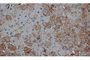 Immunohistochemistry of paraffin-embedded Human thyroid cancer tissue using MPO Polyclonal Antibody at dilution 1:50 (Myeloperoxidase anticorps)