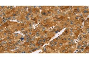 Immunohistochemistry of paraffin-embedded Human liver cancer using TNFSF15 Polyclonal Antibody at dilution of 1:40 (TNFSF15 anticorps)