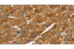 Immunohistochemistry of paraffin-embedded Human liver cancer using TNFSF15 Polyclonal Antibody at dilution of 1:40
