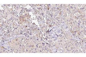 ABIN6273310 at 1/100 staining Human thyroid cancer tissue by IHC-P.