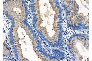 ABIN6261615 and ABIN6273239 at 1/100 staining Human colorectal cancer by IHC-P.