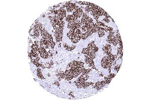 Breast Breast cancer of no special type NST HER2