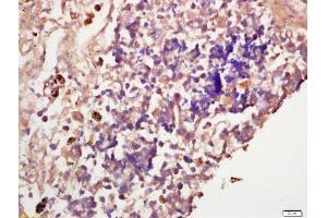 Formalin-fixed and paraffin embedded human lung carcinoma labeled with Anti-IGF2R Polyclonal Antibody, Unconjugated (ABIN719711) at 1:200 followed by conjugation to the secondary antibody and DAB staining (IGF2R anticorps  (AA 2201-2400))
