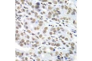 Immunohistochemistry of paraffin-embedded human gastric cancer using HDAC2 antibody (ABIN5971110) at dilution of 1/100 (40x lens). (HDAC2 anticorps)