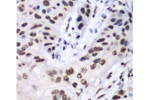 Immunohistochemistry of paraffin-embedded Human esophageal cancer using LIG3 Polyclonal Antibody at dilution of 1:100 (40x lens).