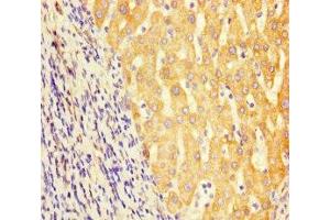 Immunohistochemistry of paraffin-embedded human liver cancer using ABIN7154056 at dilution of 1:100