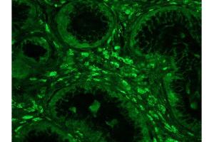 Formalin-fixed and paraffin embedded human colon carcinoma tissue labeled with Anti-Phospho-IKK alpha/beta (Ser176/Ser180) Polyclonal Antibody, Unconjugated  at 1:200 followed by conjugation to the secondary antibody, Goat Anti-Rabbit IgG, FITC conjugated-FITC). (IKK-alpha /IKK-beta anticorps  (pSer176, pSer180))