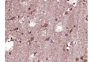 Paraformaldehyde-fixed, paraffin embedded human glioma, Antigen retrieval by boiling in sodium citrate buffer (pH6) for 15min, Block endogenous peroxidase by 3% hydrogen peroxide for 30 minutes, Blocking buffer (normal goat serum) at 37°C for 20min, Antibody incubation with Bad (Ser118) Polyclonal Antibody, Unconjugated  at 1:200 overnight at 4°C, followed by a conjugated secondary and DAB staining.