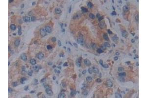 Detection of FBN1 in Human Prostate cancer Tissue using Polyclonal Antibody to Fibrillin 1 (FBN1)