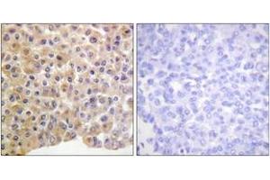 Immunohistochemistry analysis of paraffin-embedded human breast carcinoma, using IR (Phospho-Tyr1361) Antibody. (IR (AA 1331-1380), (pTyr1361) anticorps)