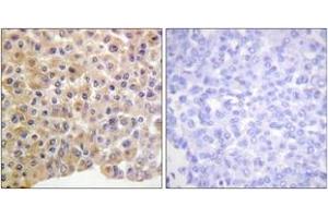 Immunohistochemistry analysis of paraffin-embedded human breast carcinoma, using IR (Phospho-Tyr1361) Antibody. (IR (AA 1331-1380), (pTyr1361) anticorps)