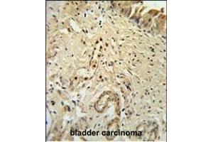 ID4 Antibody (N-term) (ABIN653935 and ABIN2843167) IHC analysis in formalin fixed and paraffin embedded bladder carcinoma followed by peroxidase conjugation of the secondary antibody and DAB staining.
