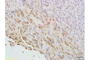 Formalin-fixed and paraffin embedded human cervical carcinoma labeled with Anti phospho-CDKN1A/P21 (Thr145) Polyclonal Antibody, Unconjugated  at 1:200 followed by conjugation to the secondary antibody and DAB staining