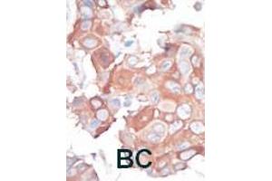 Formalin-fixed and paraffin-embedded human cancer tissue reacted with the primary antibody, which was peroxidase-conjugated to the secondary antibody, followed by AEC staining. (MAP3K1 anticorps  (C-Term))