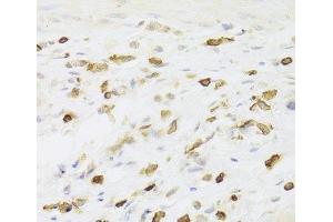 Immunohistochemistry of paraffin-embedded Human gastric cancer using LSP1 Polyclonal Antibody at dilution of 1:100 (40x lens). (LSP1 anticorps)
