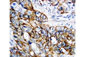 IHC-P: b-Catenin antibody testing of human breast cancer tissue