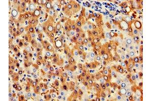 IHC image of ABIN7154972 diluted at 1:300 and staining in paraffin-embedded human liver cancer performed on a Leica BondTM system.