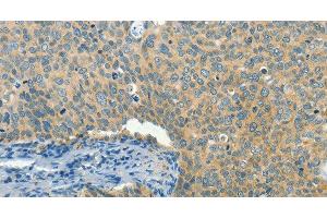 Immunohistochemistry of paraffin-embedded Human cervical cancer tissue using BCAT1 Polyclonal Antibody at dilution 1:50 (BCAT1 anticorps)
