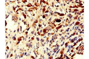 Immunohistochemistry of paraffin-embedded human melanoma using ABIN7154802 at dilution of 1:100