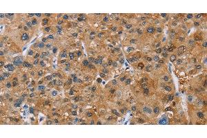 Immunohistochemistry of paraffin-embedded Human liver cancer tissue using NCR3 Polyclonal Antibody at dilution 1:40 (NCR3 anticorps)