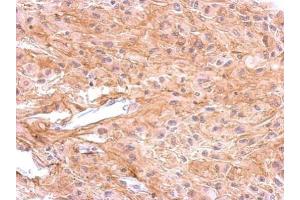 IHC-P Image Immunohistochemical analysis of paraffin-embedded U373 xenograft, using Dopamine Receptor D1, antibody at 1:500 dilution.