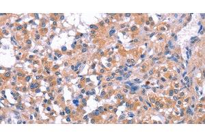 Immunohistochemistry of paraffin-embedded Human thyroid cancer tissue using ELP2 Polyclonal Antibody at dilution 1:40 (ELP2 anticorps)