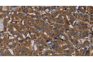 Immunohistochemistry of paraffin-embedded Human thyroid cancer tissue using PDE5A Polyclonal Antibody at dilution 1:50 (PDE5A anticorps)
