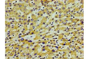 Immunohistochemistry of paraffin-embedded human liver cancer using ABIN7144407 at dilution of 1:100 (APOA5 anticorps  (AA 260-366))
