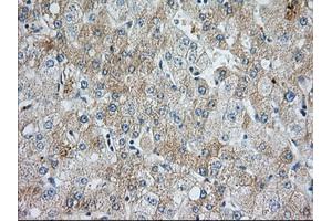 Immunohistochemical staining of paraffin-embedded Human liver tissue using anti-BIRC5 mouse monoclonal antibody. (Survivin anticorps)