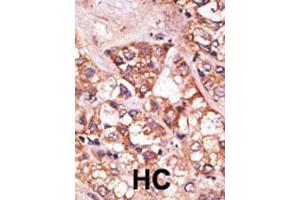 Formalin-fixed and paraffin-embedded human hepatocellular carcinoma tissue reacted with the BIK polyclonal antibody  , which was peroxidase-conjugated to the secondary antibody, followed by AEC staining. (BIK anticorps  (N-Term))