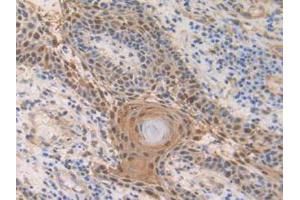 IHC-P analysis of Human Skin Cancer Tissue, with DAB staining. (S100A2 anticorps  (AA 2-98))