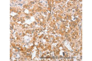 Immunohistochemistry of Human brain  using PLA2G4A Polyclonal Antibody at dilution of 1:40 (PLA2G4A anticorps)