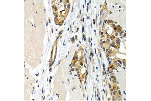 Immunohistochemistry of paraffin-embedded human stomach cancer using IL9 antibody (ABIN5974970) at dilution of 1/200 (40x lens).