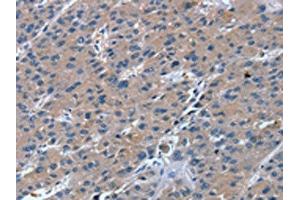 The image on the left is immunohistochemistry of paraffin-embedded Human liver cancer tissue using ABIN7130871(RGS11 Antibody) at dilution 1/20, on the right is treated with fusion protein. (RGS11 anticorps)