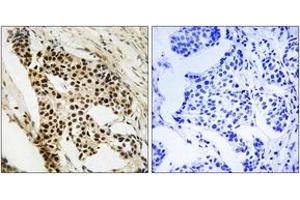 Immunohistochemistry analysis of paraffin-embedded human breast carcinoma tissue, using MAPKAPK2 (Ab-272) Antibody. (MAPKAP Kinase 2 anticorps  (AA 238-287))