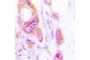 Immunohistochemical analysis of Cytokeratin 19 staining in human lung cancer formalin fixed paraffin embedded tissue section. (Cytokeratin 19 anticorps  (C-Term))