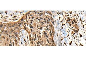 Immunohistochemistry of paraffin-embedded Human esophagus cancer tissue using CCDC113 Polyclonal Antibody at dilution of 1:65(x200) (CCDC113 anticorps)