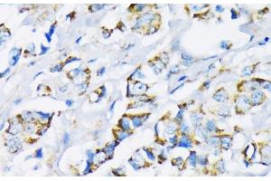 Immunohistochemistry of paraffin-embedded Human breast cancer using HK2 Polyclonal Antibody at dilution of 1:200 (40x lens). (Hexokinase 2 anticorps)