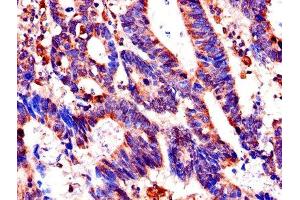 Immunohistochemistry of paraffin-embedded human colon cancer using ABIN7156155 at dilution of 1:100