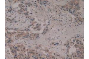 IHC-P analysis of Human Breast Cancer Tissue, with DAB staining. (CIRBP anticorps  (AA 1-172))