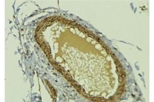 ABIN6278772 at 1/100 staining Human breast cancer tissue by IHC-P.