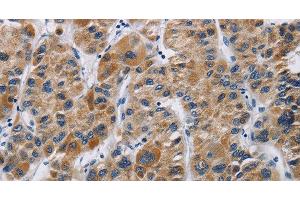 Immunohistochemistry of paraffin-embedded Human liver cancer using IFNGR2 Polyclonal Antibody at dilution of 1:40 (IFNGR2 anticorps)